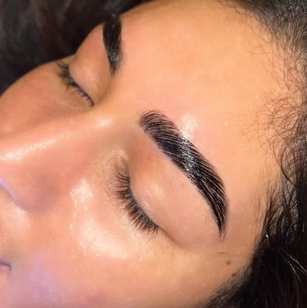 Après - Browlift exemple 1