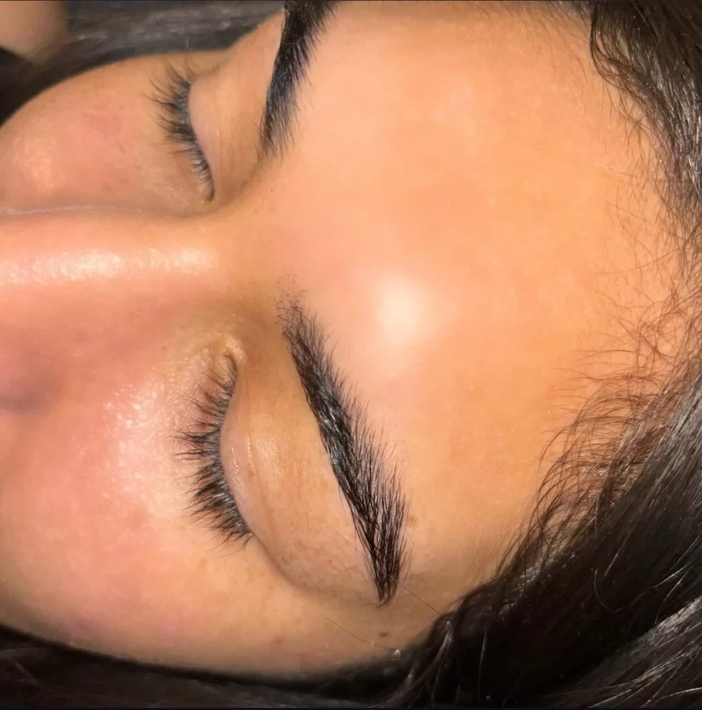 Avant - Browlift exemple 1