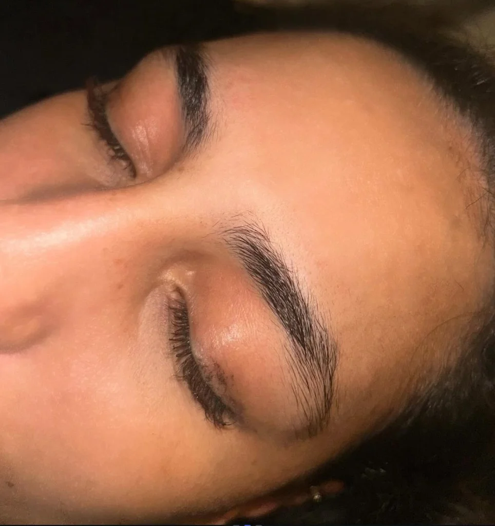 Avant - Browlift exemple 2