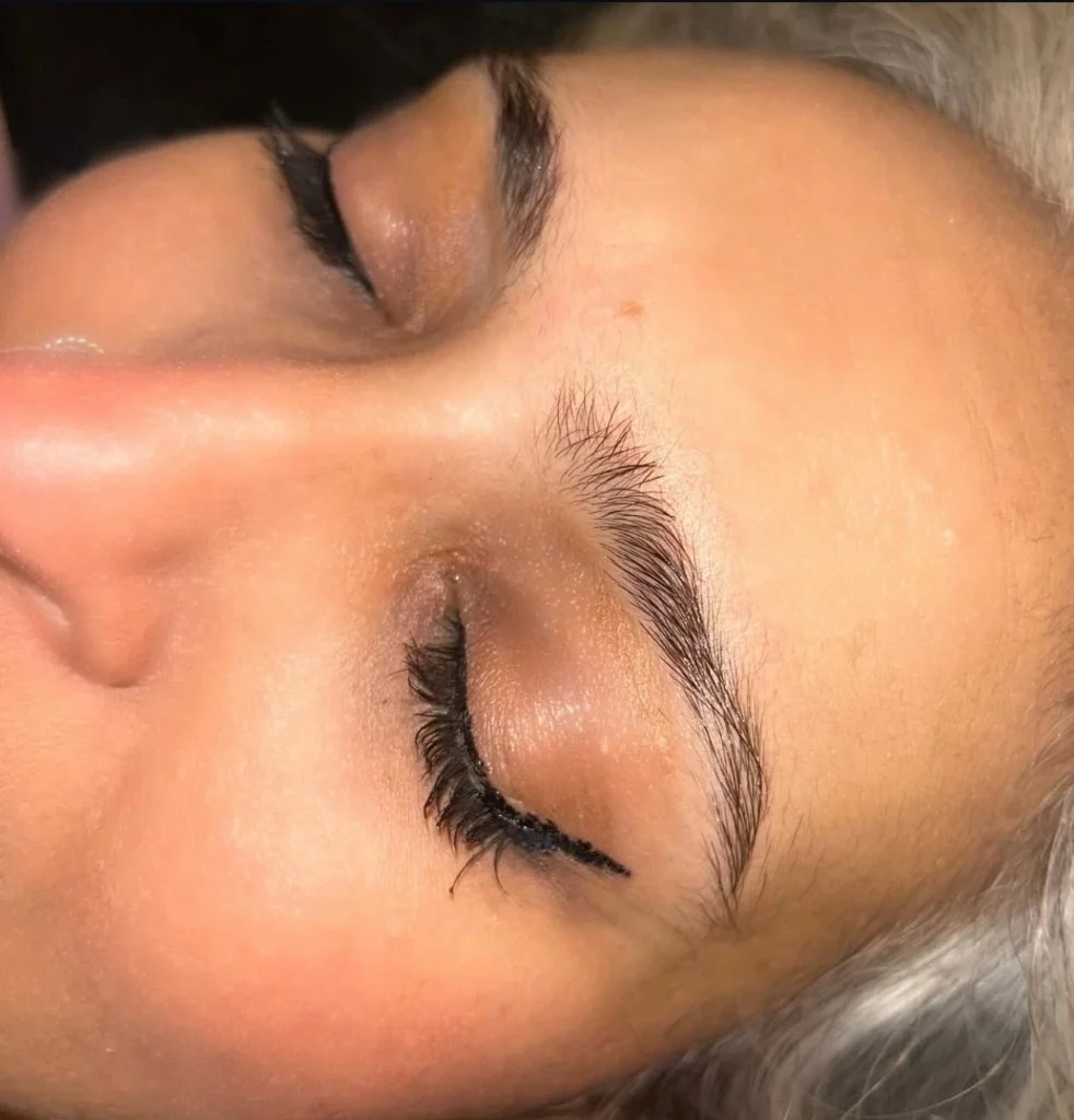 Avant - Browlift exemple 3