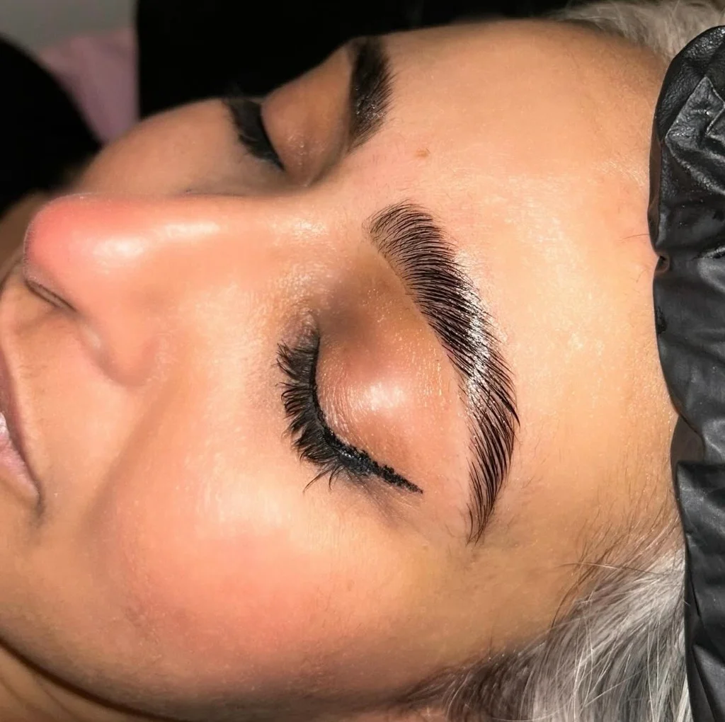 Après - Browlift exemple 3