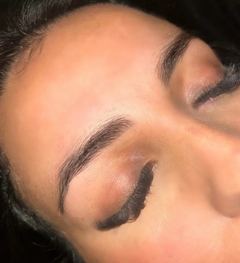 Avant - Browlift exemple 4